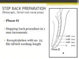 Endodontics: 6 Step Back Technique Steps With Diagram  Step Back Preparation
