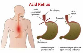 6 Foods That Ease The Symptoms Of Acid Reflux Acid Reflux Bile