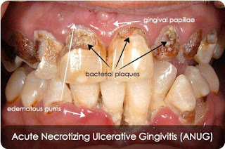 Acute Necrotizing Ulcerative Gingivitis ( Anug ) Acute Necrotizing Ulcerative Gingivitis ( Anug )