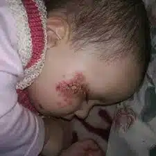 How To Treat Alefo In Babies Effectively Alefo In Babies