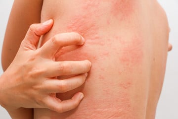 Find Allergy Treatment To Obtain Optimum Relief Allergy