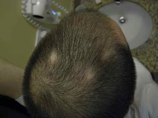 Alopecia Areata: What Is The, Diagnosis, And How Is It Tested Alopecia Areata: What Is The, Diagnosis, And How Is It Tested