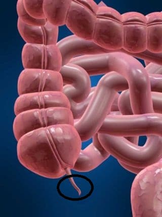 Appendectomy – How Much Does Appendix Surgery Cost? Appendix Surgery Cost In Nigeria