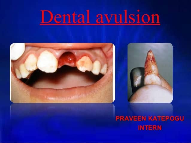 Avulsed Tooth: Treatment For Managing Knock Out Tooth Avulsed Tooth