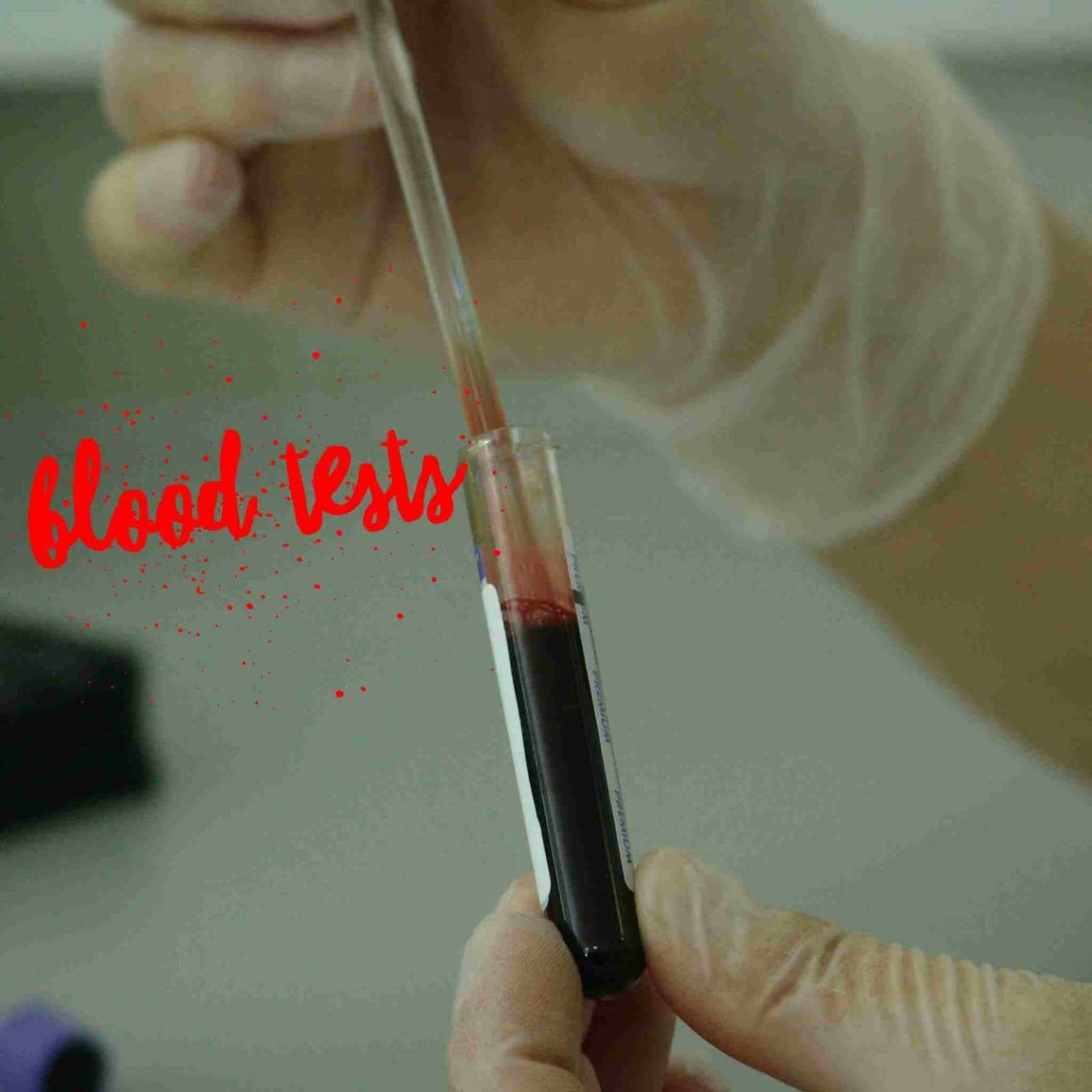 Blood Tests: Red And White Blood Cells, Lab Test And Other Factors Laboratory Blood Test
