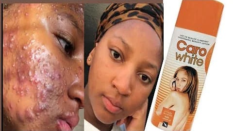 Carowhite Review: What Nobody Will Tell You! Caro White Review