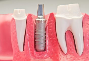 Dental Implants Used For More Than Cosmetic Dentistry Dental Implants Used For More Than Cosmetic Dentistry