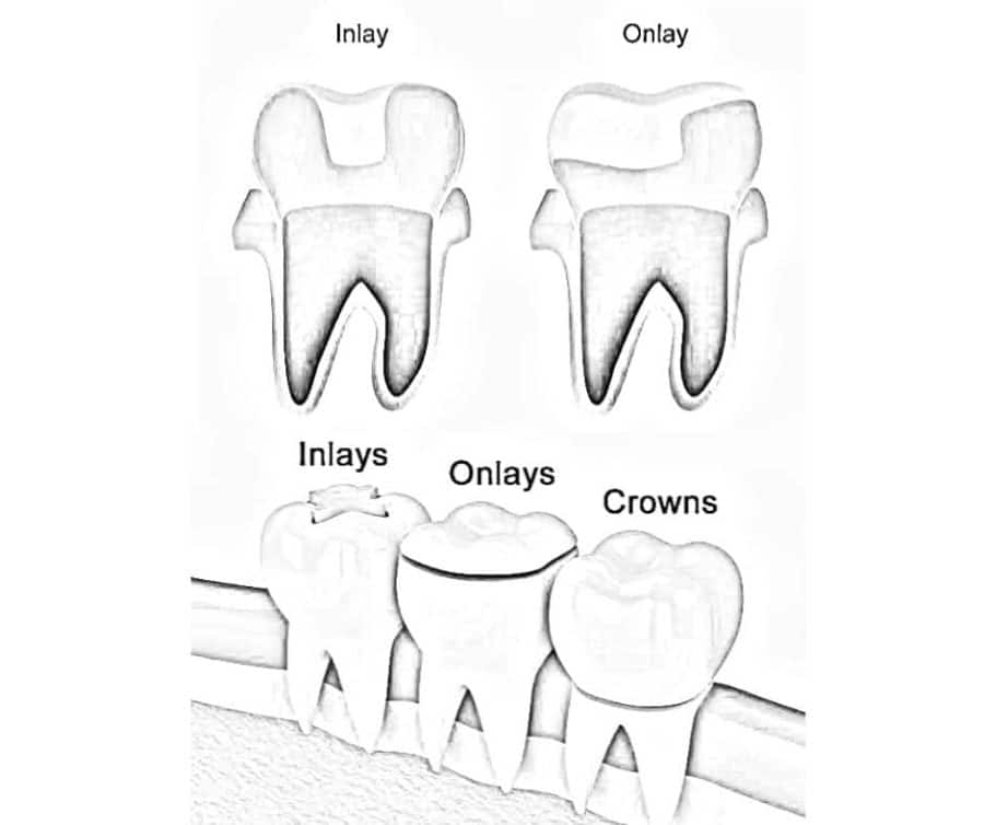 About Dental Inlays And Onlays: Restore Damaged Teeth About Dental Inlays And Onlays: Restore Damaged Teeth