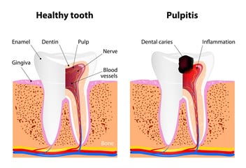 Management Of Acute Pulpitis And Pulp Polyp Management Of Acute Pulpitis And Pulp Polyp
