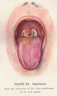 Diphtheria: Causes; Treatment And Care Of The Patient Diphtheria: Causes; Treatment And Care Of The Patient