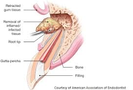 Endodontic Surgery: Root Canal And Apicoectomy Explained Endodontic Surgery: Root Canal And Apicoectomy Explained