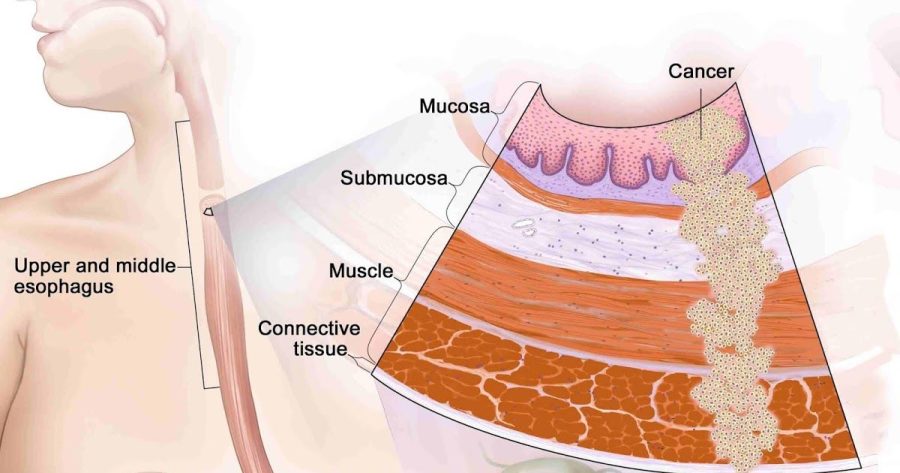 The Basic Guide: Esophageal Cancer The Basic Guide: Esophageal Cancer