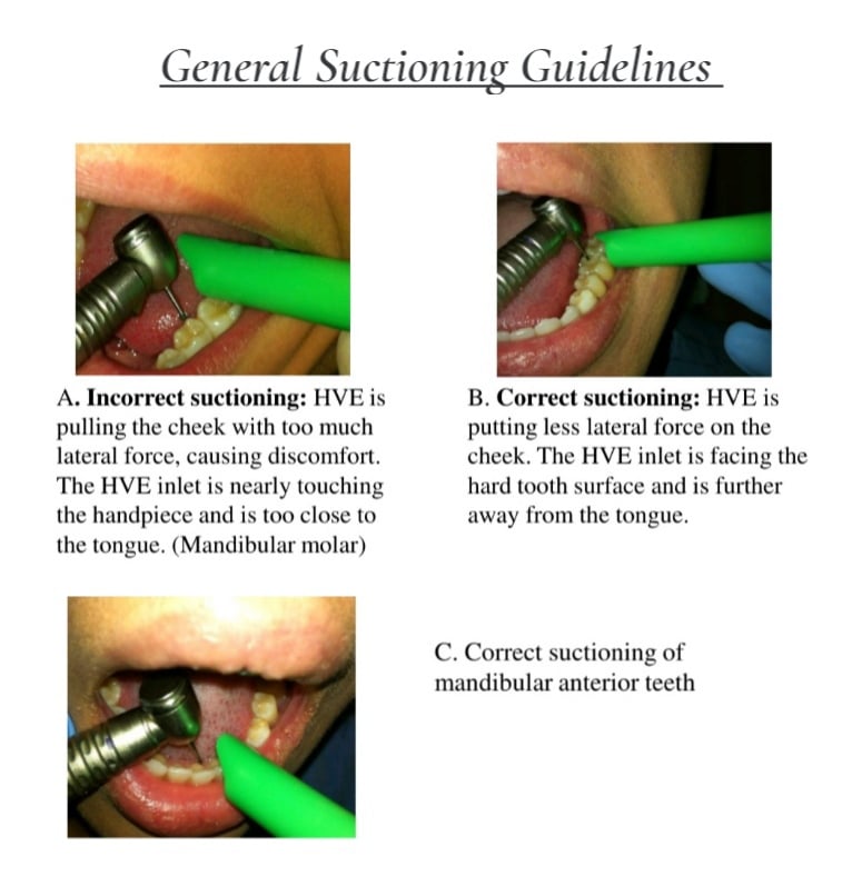 How To Properly Use A Dental Suction: 6 Step By Step Techniques How To Properly Use A Dental Suction