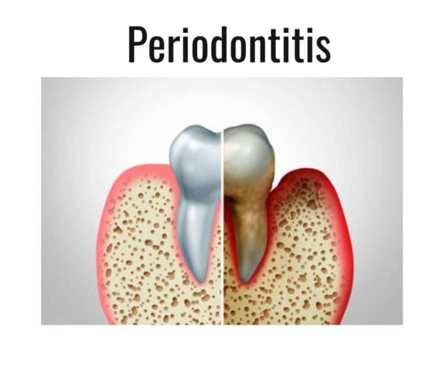 How Can I Tell If I Have Gingivitis Or Periodontitis (Gum Disease)? Gingivitis Or Periodontitis Picture