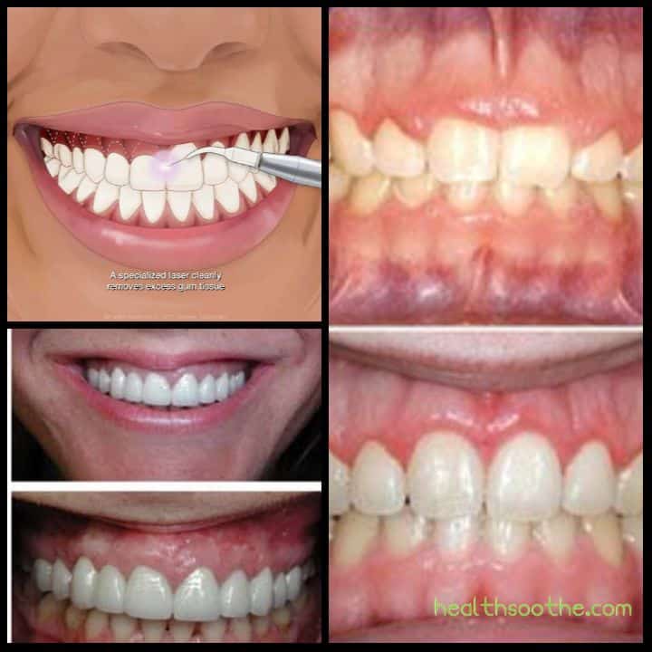 Gum Contouring: Best Candidates, Treatments, And Insurance Gum Contouring: Best Candidates, Treatments, And Insurance