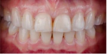 Say Goodbye To Your Gummy Smile! Gummy Smile