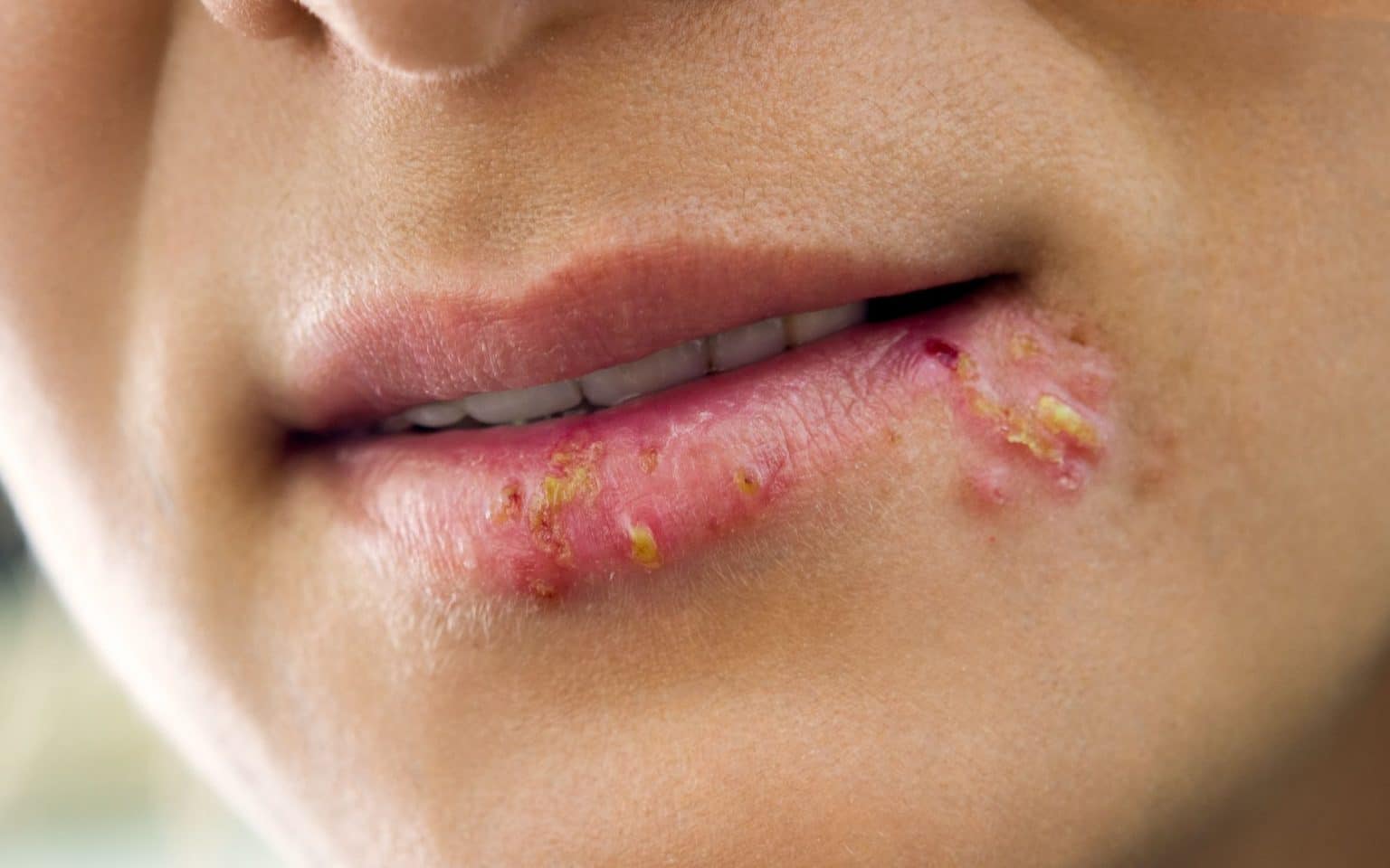 Herpes 101: 6 Things You Need To Know Herpes On The Lips Of The Young Woman