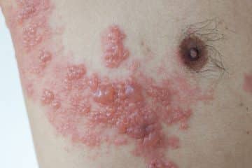 Herpes 101: 6 Things You Need To Know Herpes Zoster