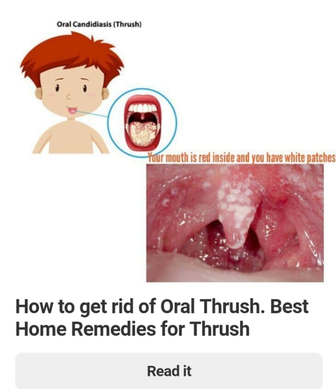 10 Ways To Get Rid Of Oral Thrush. Best Home Remedies For Thrush Oral Thrush