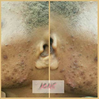 How To Get Rid Of Acne(Pimples ), Blackheads And Boil Naturally Acne