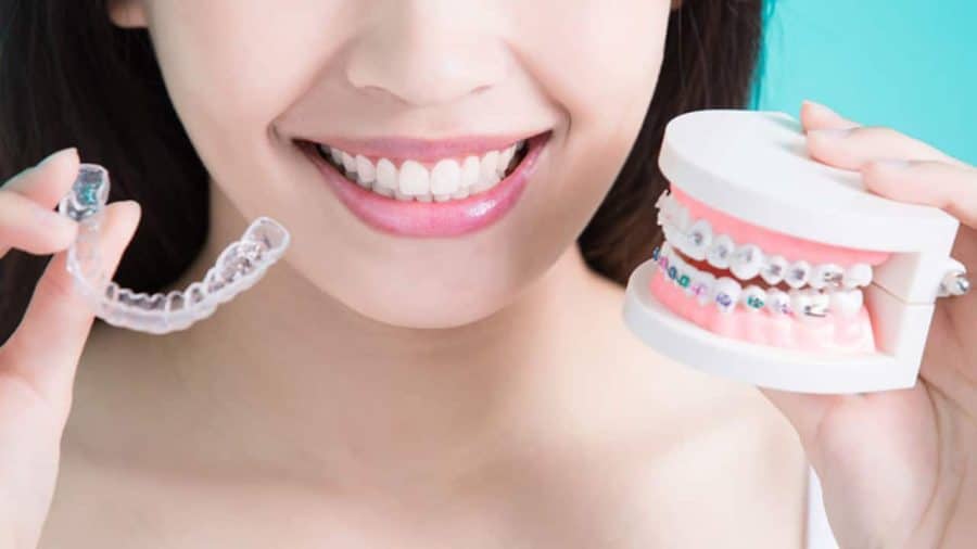 Invisalign: Long-Term Oral Health Benefits Getting Braces Soon? Here'S A Guide On Different Kind Of Braces