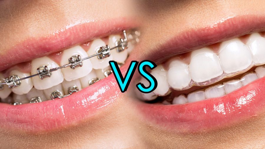 Top 3 Most Popular Types Of Braces Find Out Which Is Better - Invisalign Or Braces