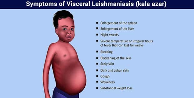 Kala Azar (Visceral Leishmaniasis): Prevention, Causes, Treatment Kala Azar