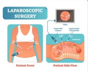 Cost Of Laparoscopy In Nigeria : All You Need To Know Cost Of Laparoscopy In Nigeria