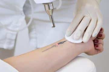 Top 4 Reasons To Consider Laser Tattoo Removal Laser Tattoo Removal
