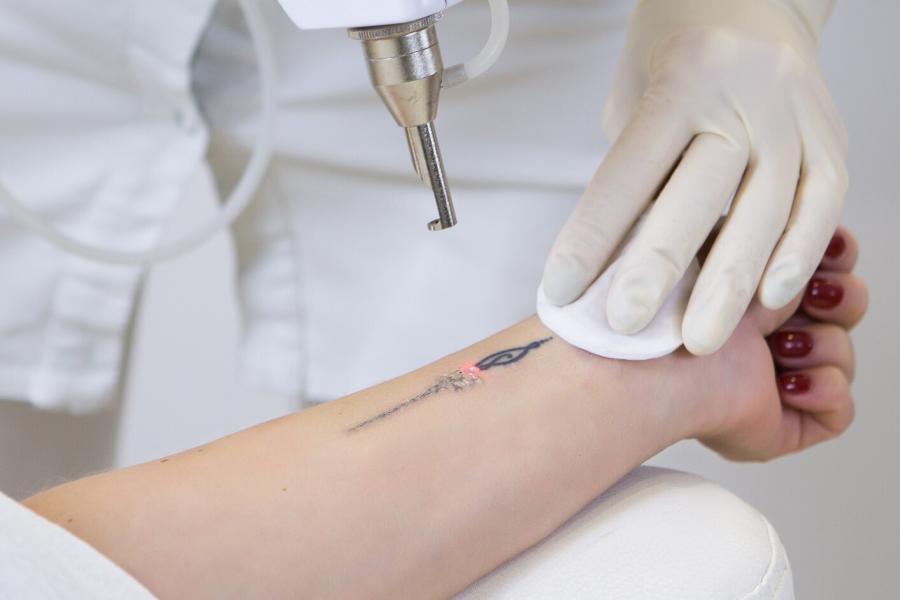 Tattoos - Numbing Creams & Aftercare  Laser Tattoo Removal