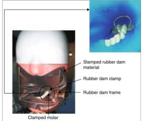 5 Instrument Used For Rubber Dam Placement Mannequin With Rubber Dam In Place
