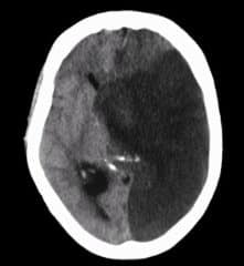 Midline Brain Shift | What You Need To Know About This Condition (With Pictures, Videos &Amp; Faqs) Midline Brain Shift - Healthsoothe