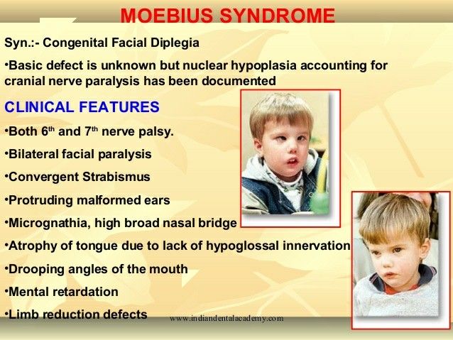 Moebius Syndrome: Causes, Symptoms, And Treatment Moebius Syndrome
