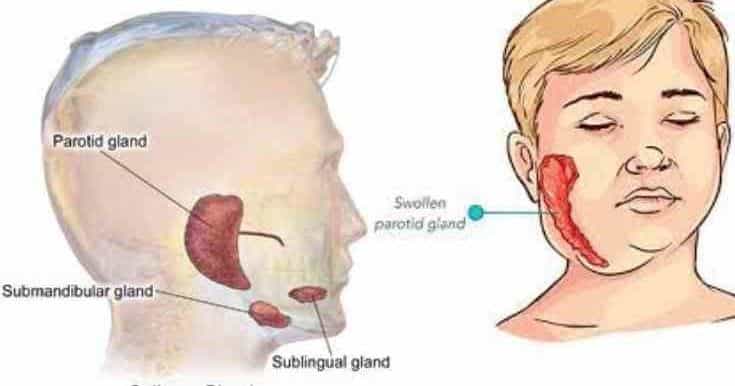 Mumps: Symptoms, Causes, Treatments, Home Remedies Mumps