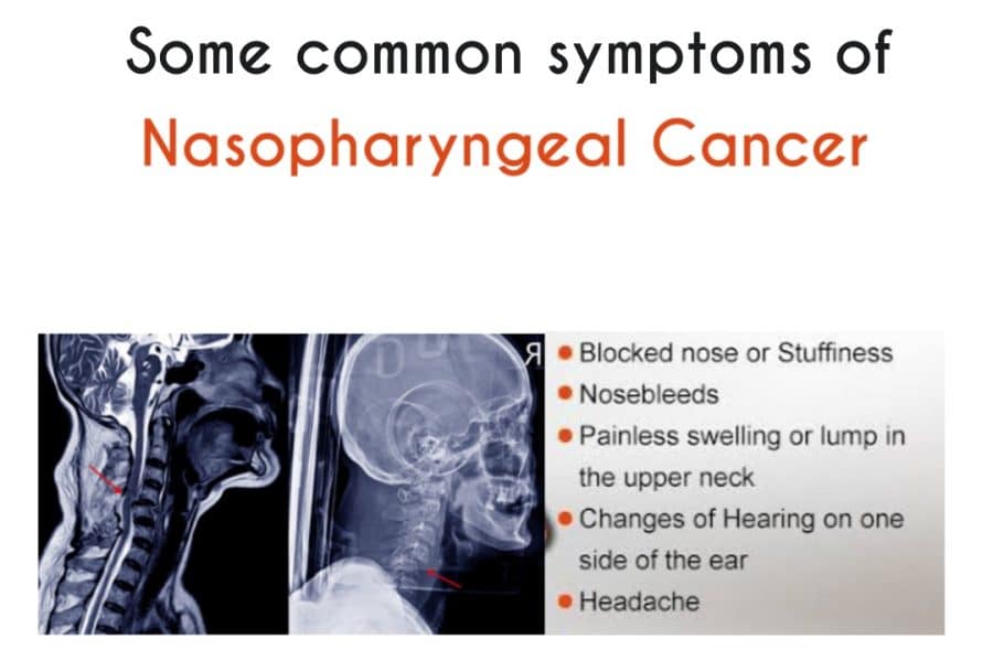 What You Need To Know About Nasopharyngeal Cancer Nasopharyngeal Cancer