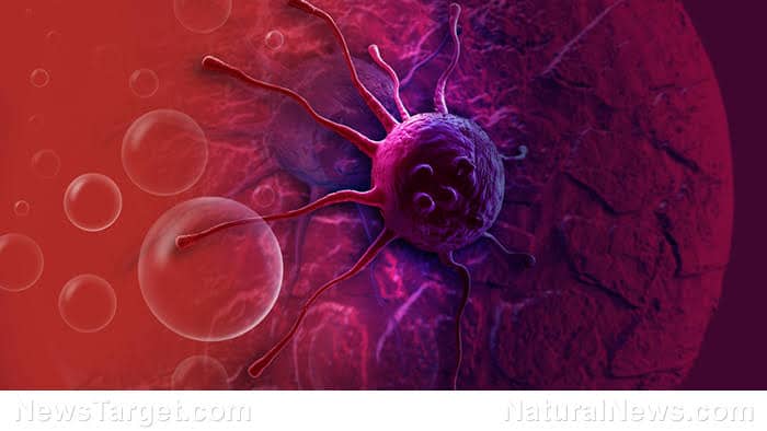 Neoplasm: What Is, Causes, Effects, Types And Treatment Neoplasm