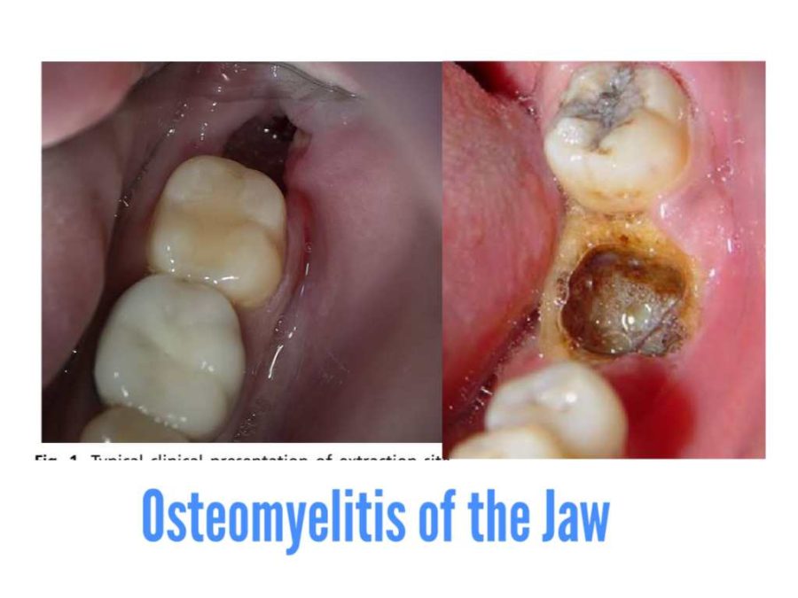 What Is Osteomyelitis And How Does It Enter The Bone? Osteomyelitis Of The Jaw