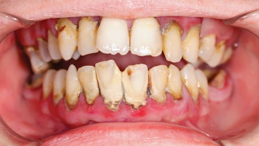 Periodontal Disease: Causes, Symptoms And Home Treatment. Periodontal-Disease