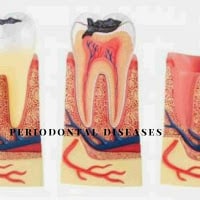 Periodontal Disease: Causes, Symptoms And Home Treatment. Periodontal-Disease