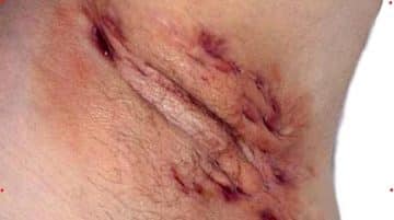 6 Causes And Treatment Of Pimple-Like Bump On Clitoral Hood Pimple-Like Bump Ob Clitoral Hood (Causes)