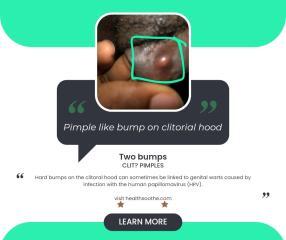 6 Causes And Treatment Of Pimple-Like Bump On Clitoral Hood Pimple Like Bump On Clitorial Hood