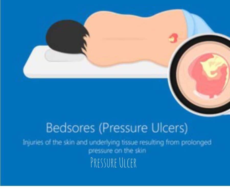 Pressure Ulcer Risk Assessment Vs. Clinical Judgment Pressure Ulcer Risk Assessment Vs. Clinical Judgment