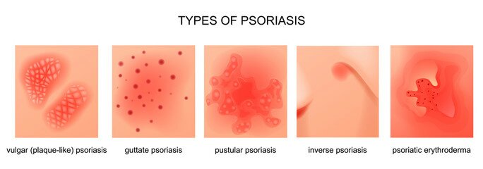 Ayurvedic Treatment Of Psoriasis Psoriasis