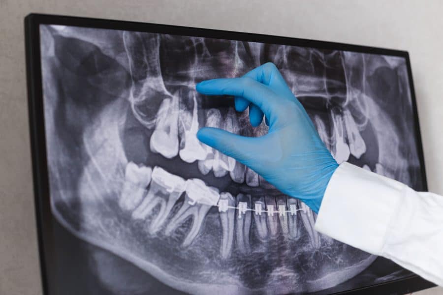 6 Signs You Need Root Canal Treatment Asap Root Canal Treatment