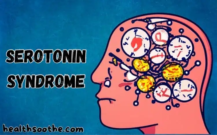 What You Should Know About Serotonin Syndrome Serotonin Syndrome
