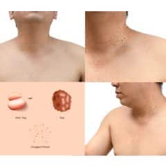 8 Ways To Get Rid Of Pesky Skin Tags Skin Tags