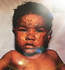 Smallpox: Causes, Treatment, And Vaccination Processes Smallpox