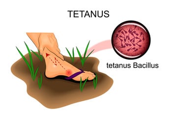Tetanus Causes, Symptoms, Prevention, And Treatment Tetanus