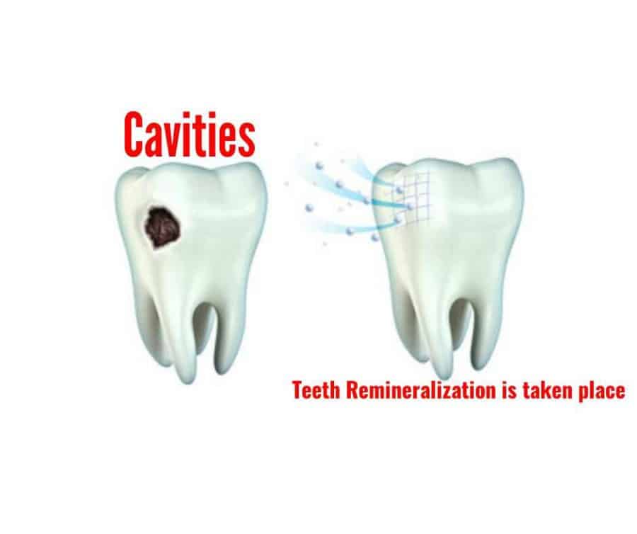 3 Steps To Achieve Teeth Remineralization And Whitening Them Teeth Remineralization