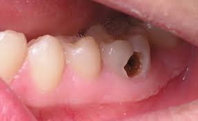 Tooth Decay: Causes, Symptoms, Prevention, Treatment, And Self Care Tooth Decay